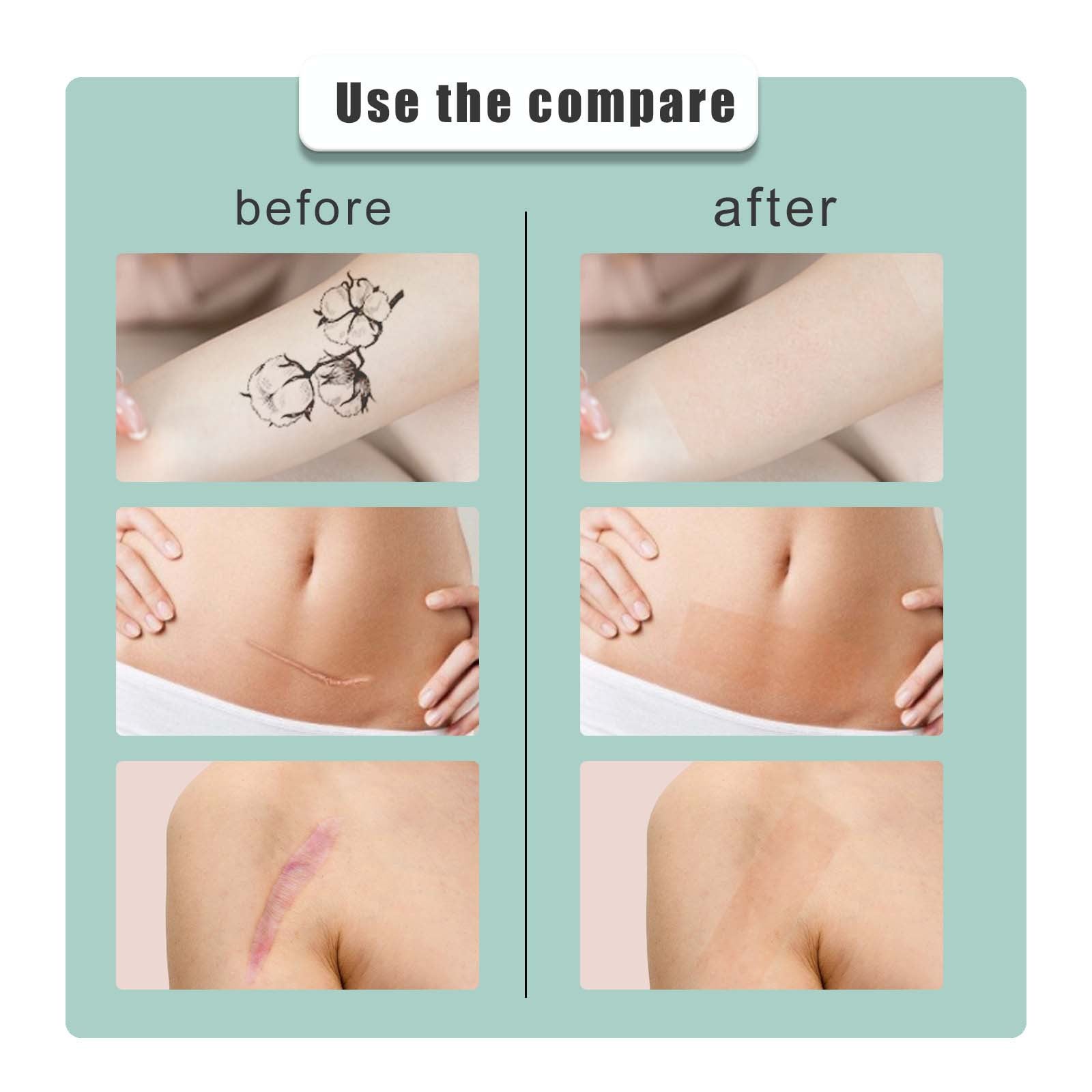 South Moon Skin Tone Concealer Patches, Waterproof Skin Tone Invisible Patches for Skin Scars, Tattoos, Acne Marks