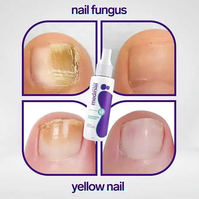 Jaysuin - Nail Fungus Spray